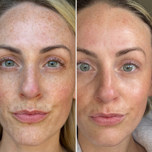 Before and after comparison of a woman's face with visible skin texture differences.