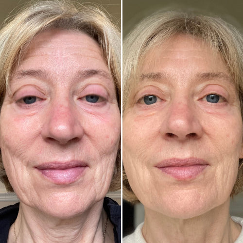 Before and after comparison of a woman's face with visible aging signs.